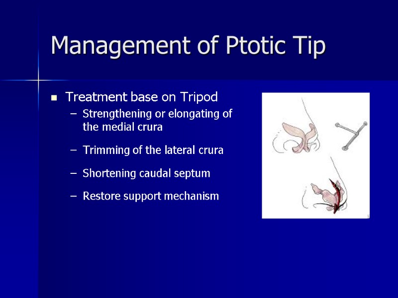 Management of Ptotic Tip Treatment base on Tripod  Strengthening or elongating of the